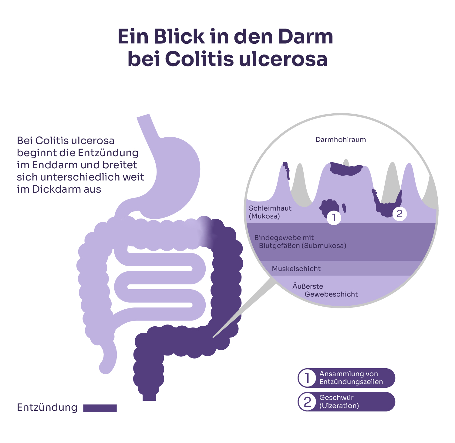 Darmquerschnitt: Das Entzündungsmuster bei Colitis ulcerosa