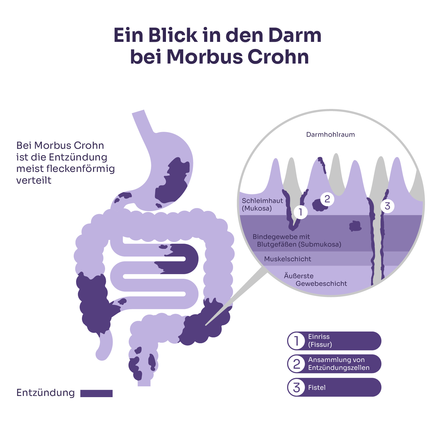 Darmquerschnitt: Das Entzündungsmuster bei Morbus Crohn