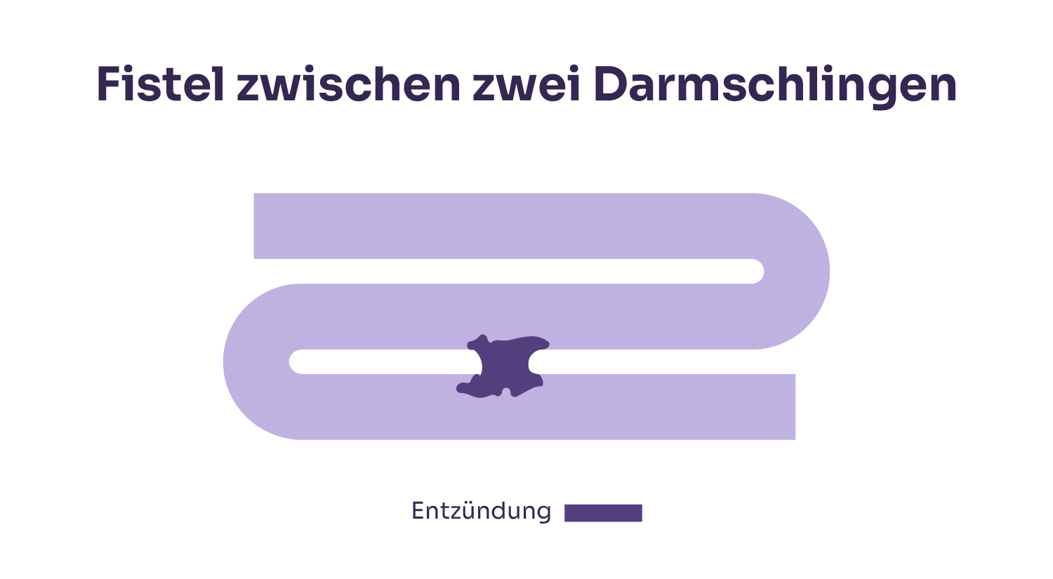 Morbus Crohn: Fistel zwischen zwei Darmschlingen